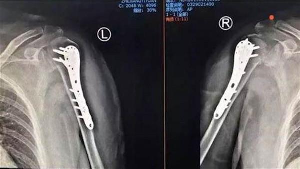 Hi hữu: Vợ đột nhiên bị gãy cả hai tay sau khi chồng ôm thắm thiết - 3