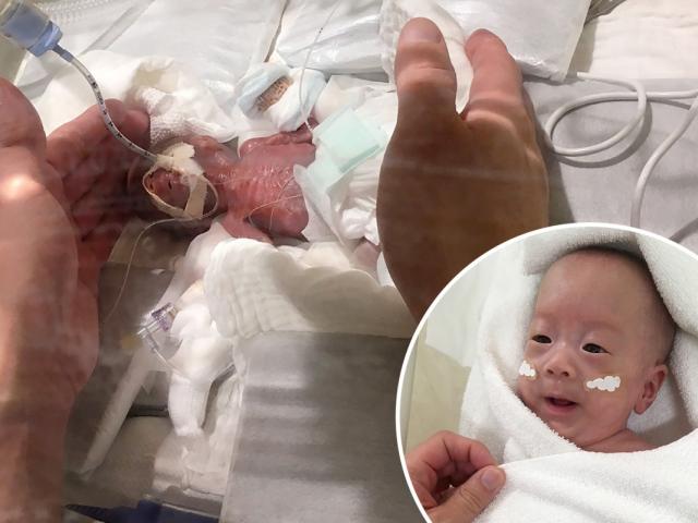 Bé sơ sinh chỉ nặng 3 lạng, bé đến nỗi nằm gọn trong bàn tay bác sĩ giờ ra sao?