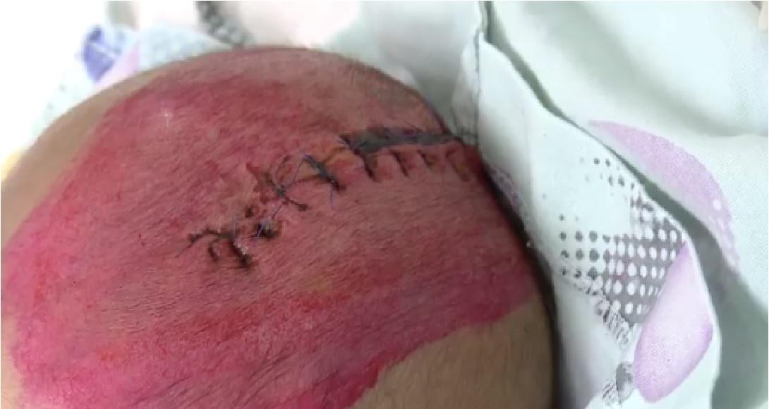 Bất cẩn để điện thoại rơi trúng đầu con, bé gái 2 tháng tuổi bị chấn thương sọ não - 1