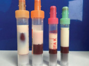 Sức khỏe - Căn bệnh có thể khiến 30% dân số nước ta bị máu “trắng như sữa”