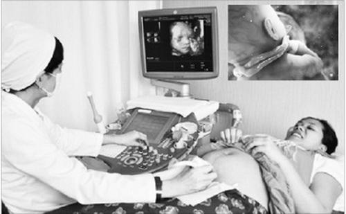 Giải mã hiện tượng “tràng hoa quấn cổ” thai nhi khiến nhiều mẹ bầu lo lắng - 1