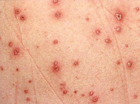 Bệnh thủy đậu ở trẻ em: Triệu chứng và cách chăm sóc - 4