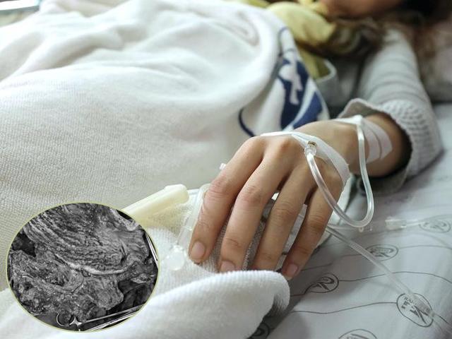 Cô giáo Hà Nội cắt toàn bộ dạ dày vì ung thư, đừng chủ quan khi đầy bụng, ợ hơi