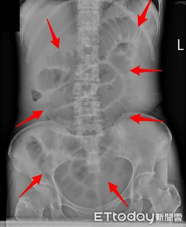Ruột người phụ nữ phình to, suýt hoại tử vì kiểu ăn uống tuy tốt nhưng nhiều người làm sai - 1