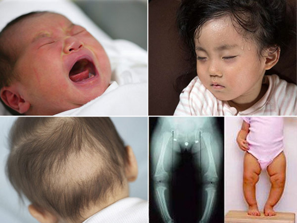 Sai lầm kinh điển của mẹ Việt khi bổ sung vitamin D khiến con thấp còi - 1