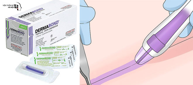 Phẫu thuật không khâu da – Giải pháp trọn vẹn cho lĩnh vực phẫu thuật thẩm mỹ - 3