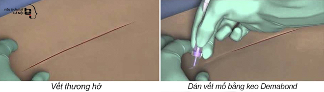 Phẫu thuật không khâu da – Giải pháp trọn vẹn cho lĩnh vực phẫu thuật thẩm mỹ - 4