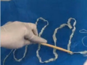 Tin tức - Hãi hùng cảnh bác sĩ bắt sán lợn trưởng thành dài 5,2 mét trong cơ thể cô gái trẻ