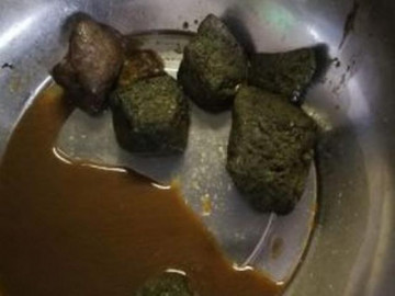 Dạ dày có 10 viên sỏi to như trứng vì thường xuyên ăn loại quả nhiều người thích