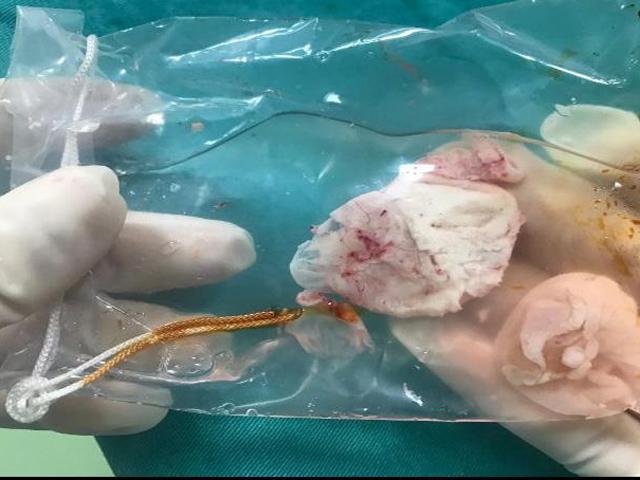 Bệnh nhân có ổ sán khổng lồ trong não gây liệt nửa người vì kiểu ăn uống nhiều người mắc