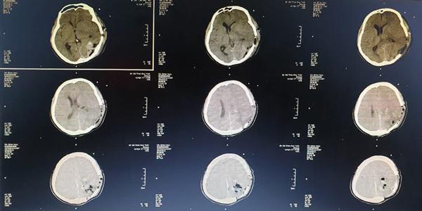 Bệnh nhân có ổ sán khổng lồ trong não gây liệt nửa người vì kiểu ăn uống nhiều người mắc - 2