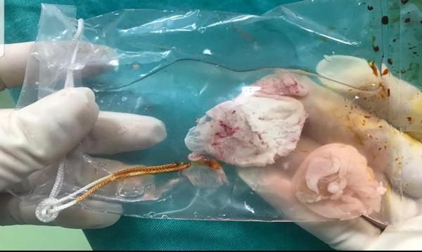 Bệnh nhân có ổ sán khổng lồ trong não gây liệt nửa người vì kiểu ăn uống nhiều người mắc - 3