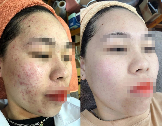 Loại bỏ mụn - thâm - sẹo sau 2 tháng, cô gái lấy lại làn da mịn màng trắng hồng - 3
