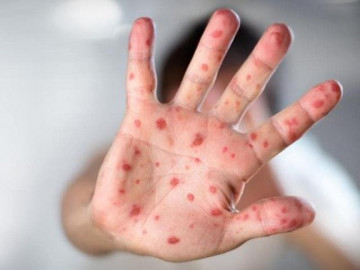 Dấu hiệu nhận biết và cách đánh bay bệnh sởi