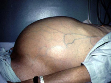 Con trai bị ung thư gan, con gái nhiễm virus viêm gan B vì cha mẹ coi thường việc này