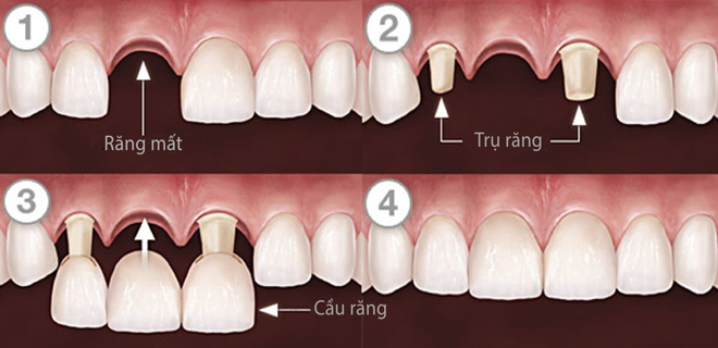 Trồng răng sứ: Giải pháp phục hình răng thẩm mỹ và chắc khỏe