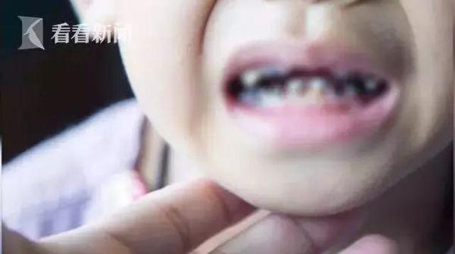 uong loai nuoc nay moi ngay khien ham rang cua cau be 2 tuoi bi hu hai nghiem trong - 1