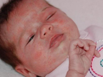 Trẻ bị dị ứng: Biểu hiện và nguyên nhân gây phản ứng ở cơ thể