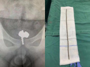 Tin tức - Con trai 11 tuổi bị tiểu buốt, bố mẹ đưa đi khám tá hỏa phát hiện thứ này trong người