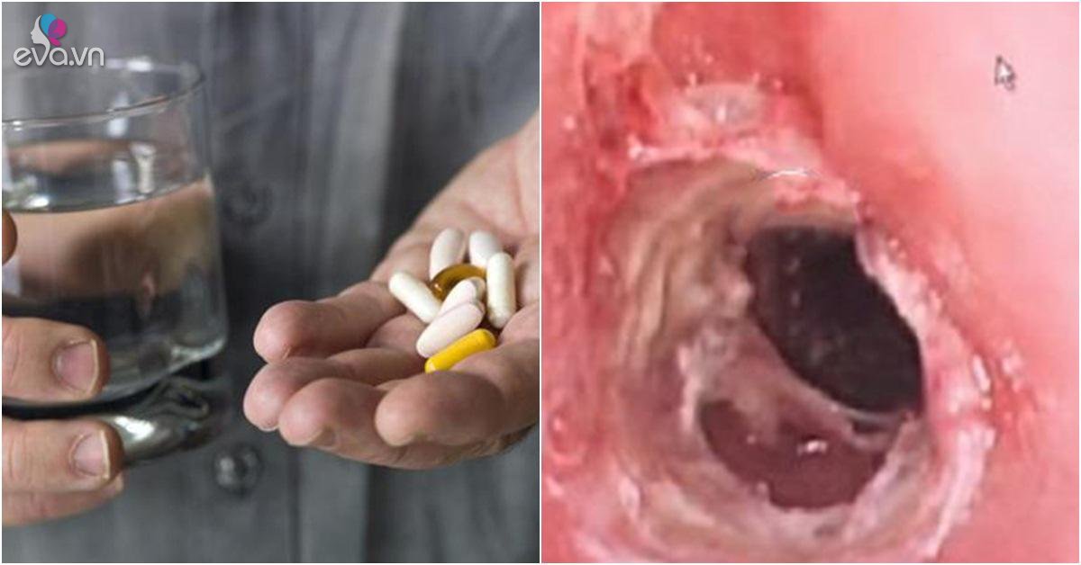 Chàng trai trẻ bị ăn mòn dạ dày vì quên một việc cực quan trọng khi uống thuốc