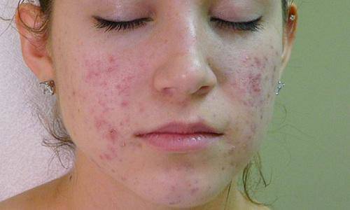 ngay nao cung skincare mun van moc nhu nam, hay ap dung ngay 2 cong thuc duoi day - 1