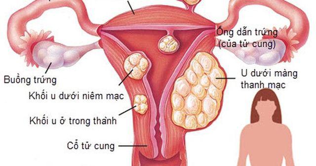 Uống thứ này suốt nhiều tháng, người phụ nữ hốt hoảng khi một đêm thay BVS tới 3 lần - 3