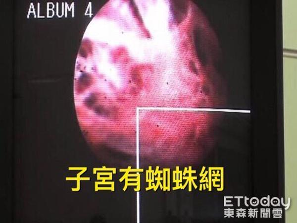 Người phụ nữ bị vô sinh suốt 8 năm, đi khám thấy “vùng kín” giăng kín như mạng nhện - 1