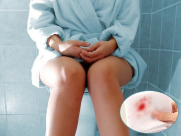 Đi vệ sinh chảy cả máu vì mắc trĩ nhưng ngại không đi khám, cô gái phải trả giá đắt