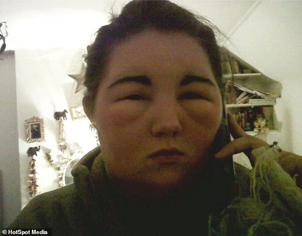 10 năm sau khi nhập viện vì nhuộm tóc, cô gái ân hận cả đời vì cuộc sống amp;#34;địa ngụcamp;#34; - 2