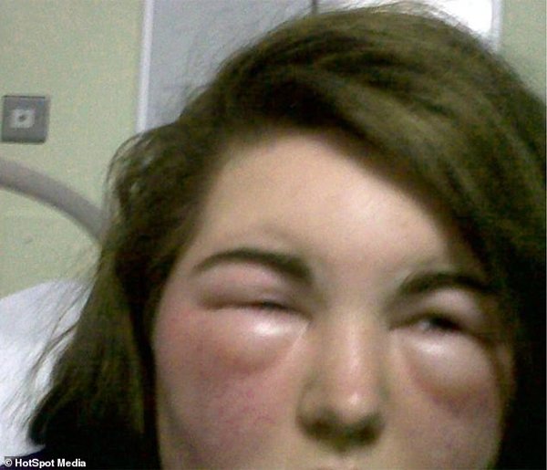 10 năm sau khi nhập viện vì nhuộm tóc, cô gái ân hận cả đời vì cuộc sống amp;#34;địa ngụcamp;#34; - 3