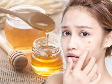 Ngày Tết bị nổi mụn, hãy cấp cứu làn da bằng những mẹo đơn giản mà hiệu quả bất ngờ