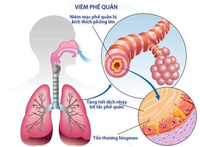 Biến chứng bệnh viêm phế quản ở trẻ em khi không điều trị kịp thời - 4