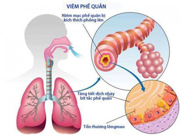 Biến chứng bệnh viêm phế quản ở trẻ em khi không điều trị kịp thời