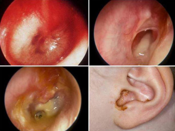 Cách chữa và chăm sóc bệnh viêm tai giữa ở trẻ em hiệu quả