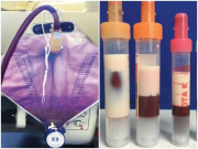 Sức khỏe - 6 trường hợp y tế kỳ lạ và cực hiếm năm 2019: "Cậu nhỏ" hóa thạch, máu trắng như mỡ