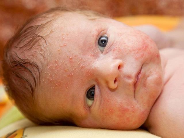 Trẻ sơ sinh bị nổi mẩn đỏ ở mặt: Nguyên nhân và cách chữa trị hiệu quả