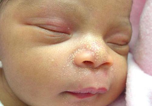 Trẻ sơ sinh bị đỏ mặt: Nguyên nhân và cách điều trị hiệu quả - 1