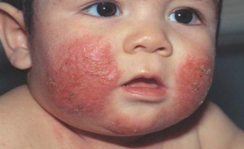Trẻ sơ sinh nổi mẩn đỏ trên mặt: Nguyên nhân và cách điều trị hiệu quả- 3