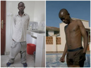 Sức khỏe - Cuộc sống của chàng trai có “cậu nhỏ” lớn gấp 20 lần người thường sau khi phẫu thuật