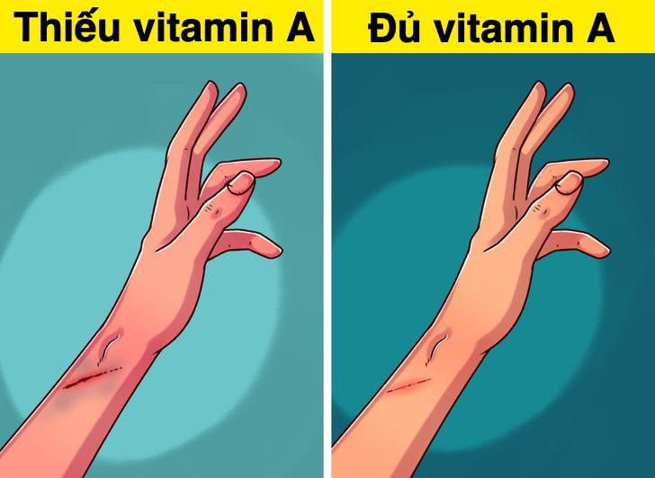 7 dấu hiệu đáng báo động cho thấy cơ thể bạn đang thiếu vitamin A, cần bổ sung gấp - 5