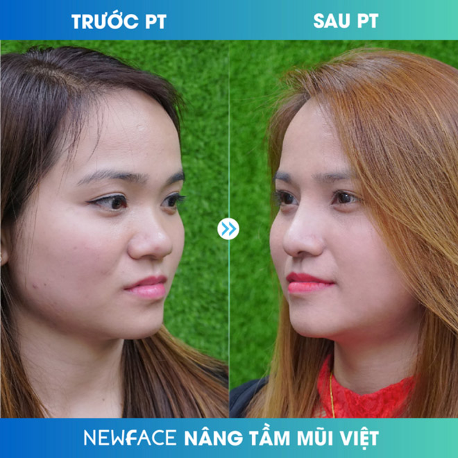 Việt Kiều ngạc nhiên khi bị thẩm mỹ viện Newface... từ chối nâng mũi - 2