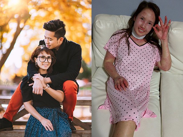 Mắc bệnh giống Selena Gomez, mẹ Việt xinh đẹp mang bầu chịu cảnh da nứt toang, ăn qua ống thở
