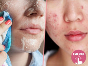 Làm đẹp - Những nguyên tắc chăm sóc da mụn bạn cần nằm lòng để có làn da căng mịn, trắng sáng