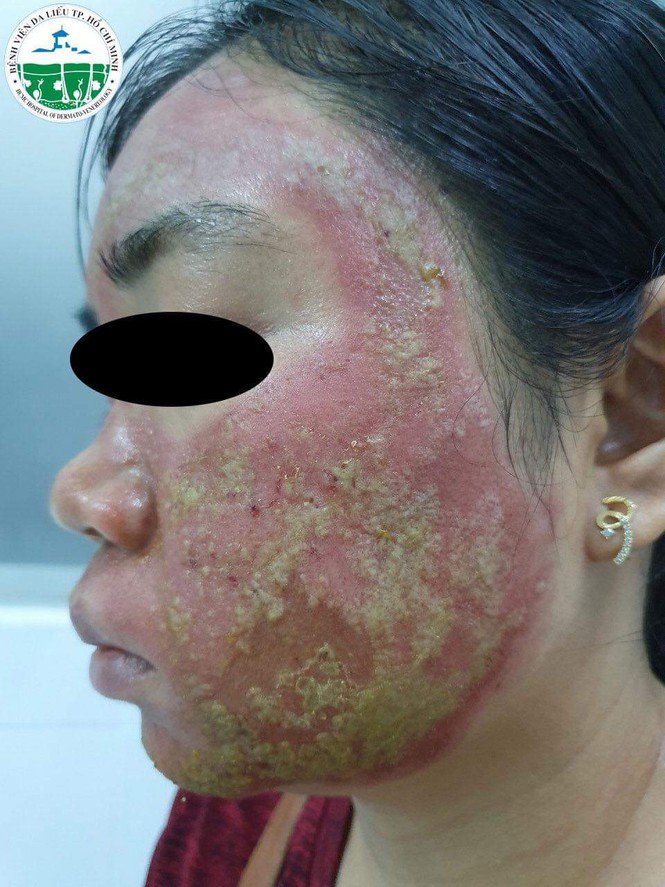 mat 40 trieu dong lan kim lam dep, nguoi phu nu ruoc hoa vi mat thanh o mu - 1
