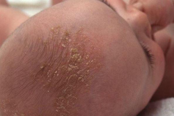 Cứt trâu ở trẻ sơ sinh xuất hiện khi nào và cách chữa trị triệt để nhất - 1
