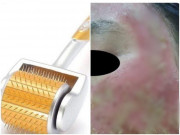 Sức khỏe - Mất 40 triệu đồng lăn kim làm đẹp, người phụ nữ rước hoạ vì mặt thành ổ mủ