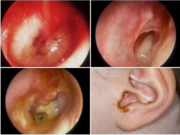 Viêm tai giữa ở trẻ em: Nguyên nhân, dấu hiệu và cách điều trị bệnh - 2