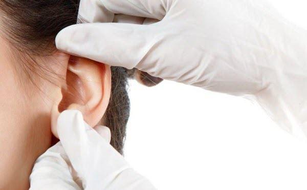 Viêm tai giữa ở trẻ em: Nguyên nhân, dấu hiệu và cách điều trị bệnh - 3