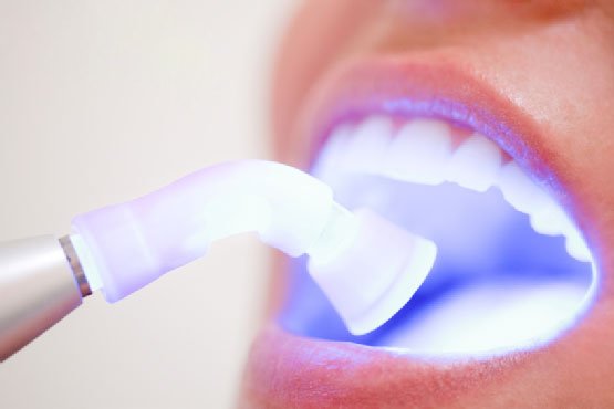 Tẩy trắng răng có hại gì với sức khỏe và có đau không? - 4
