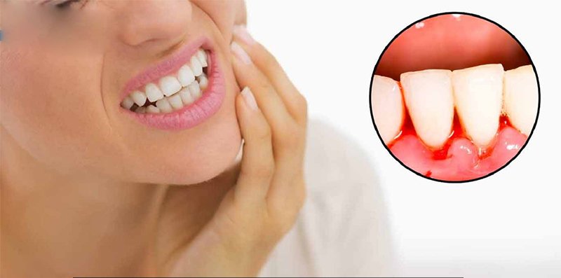 Tẩy trắng răng có hại gì với sức khỏe và có đau không? - 6